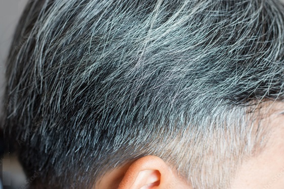 Grey Hair and Hair Transplants