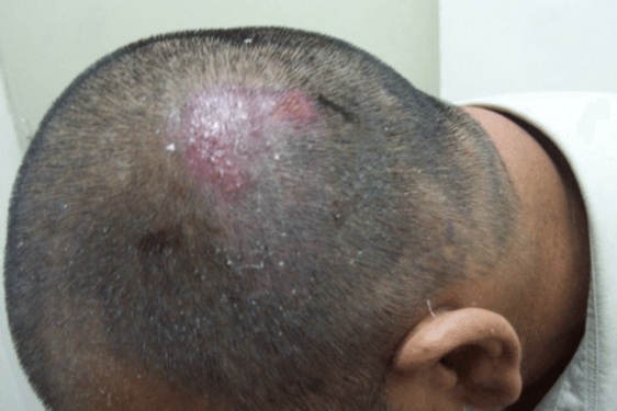 Hair Transplant Infections: Prevention, Symptoms, and Treatment